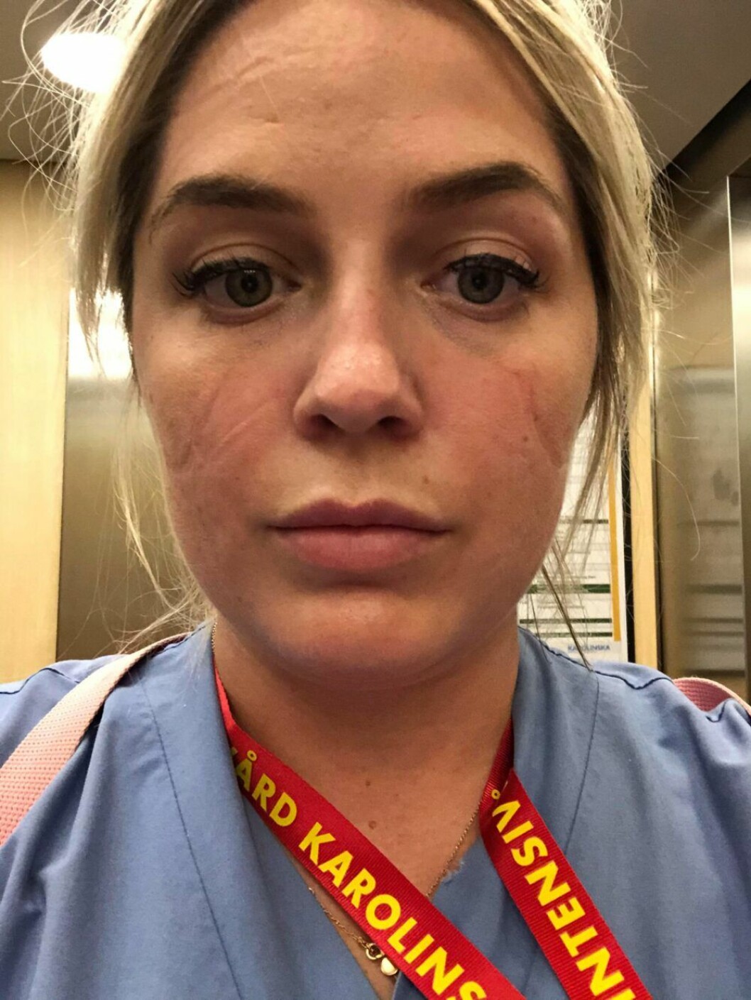 Specialistsjuksköterskan Matilda Nygren berättar att hon får skavmärken i ansiktet av skyddsutrustningen hon har på sig i salen där de sjukaste covid-19-patienterna ligger. Specialistsjuksköterskan Matilda Nygren vårdar covid-19-patienter på intensiven