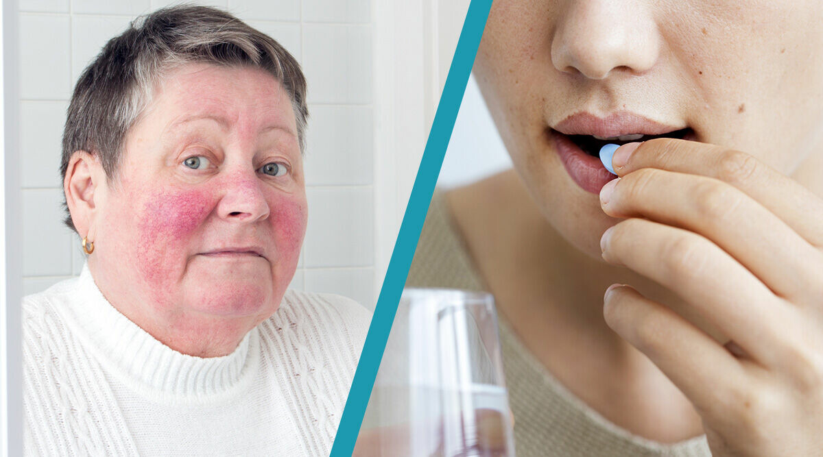 Så känner du igen Rosacea: "Viktigt att behandla tidigt"