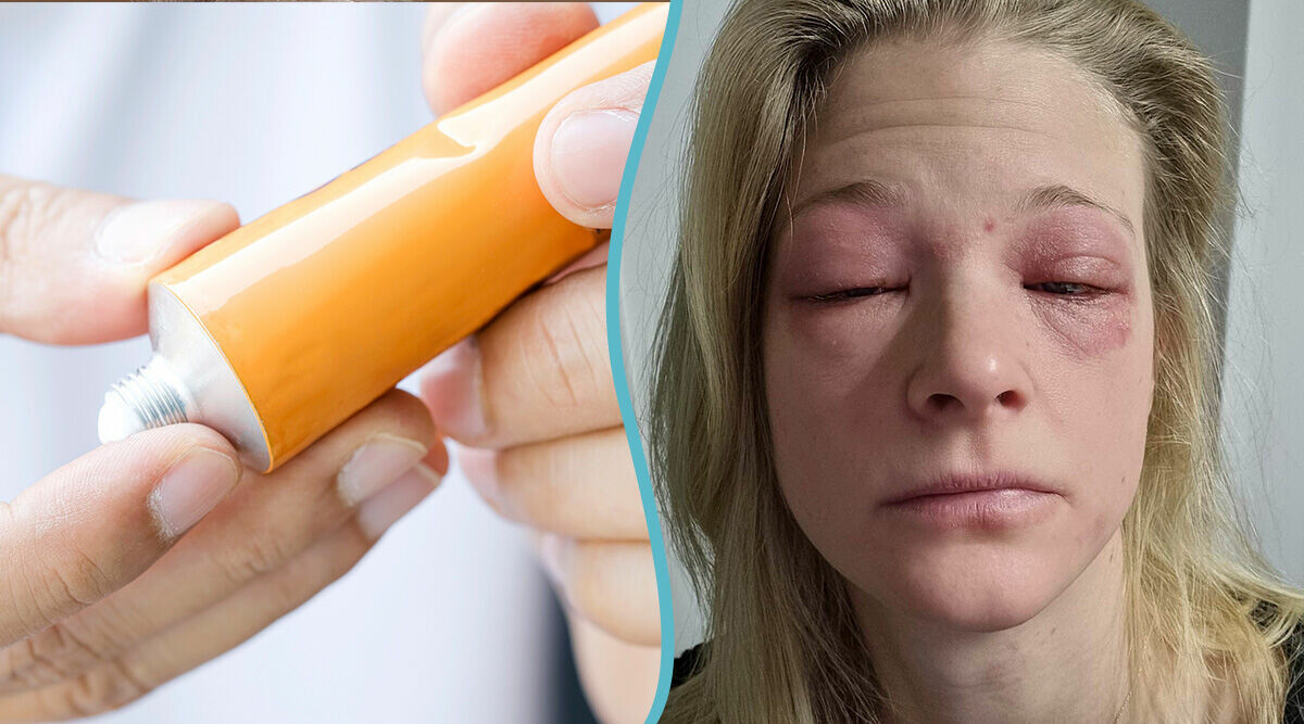 Sandra, 35, blev kortisonberoende: "Besvären exploderade"