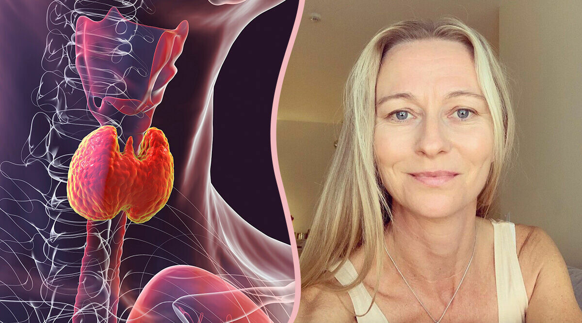 Johanne har Graves sjukdom: "Har pendlat mellan hopp och förtvivlan"