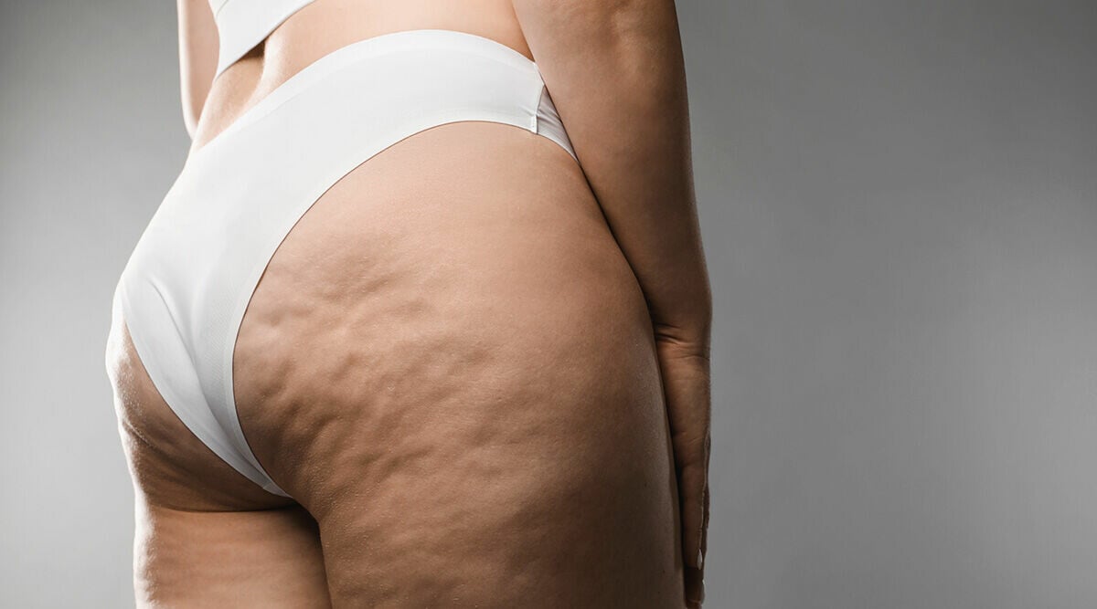 Celluliter eller lipödem? Så vet du skillnaden