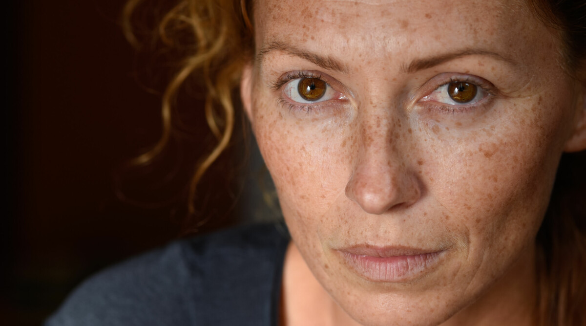 Läkaren: Då kan födelsemärket vara tecken på hudcancer