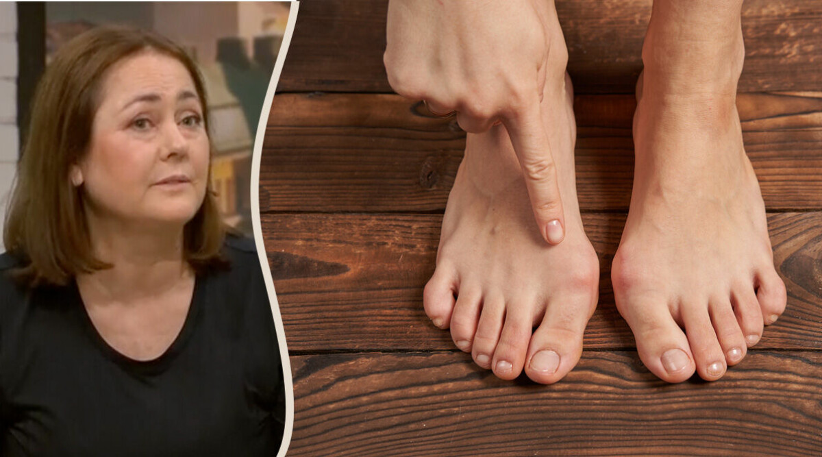 Fysioterapeutens enkla tåövning – som hjälper mot hallux valgus