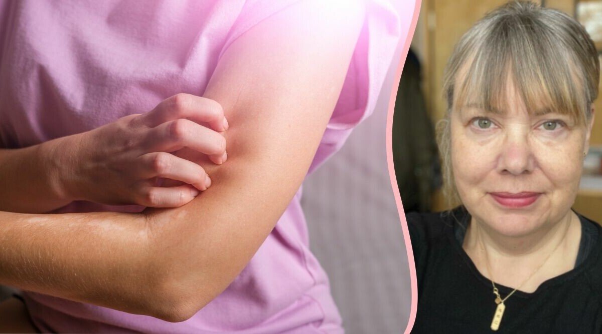 Fler är känsliga för histamin efter pandemin: "Markant ökning"