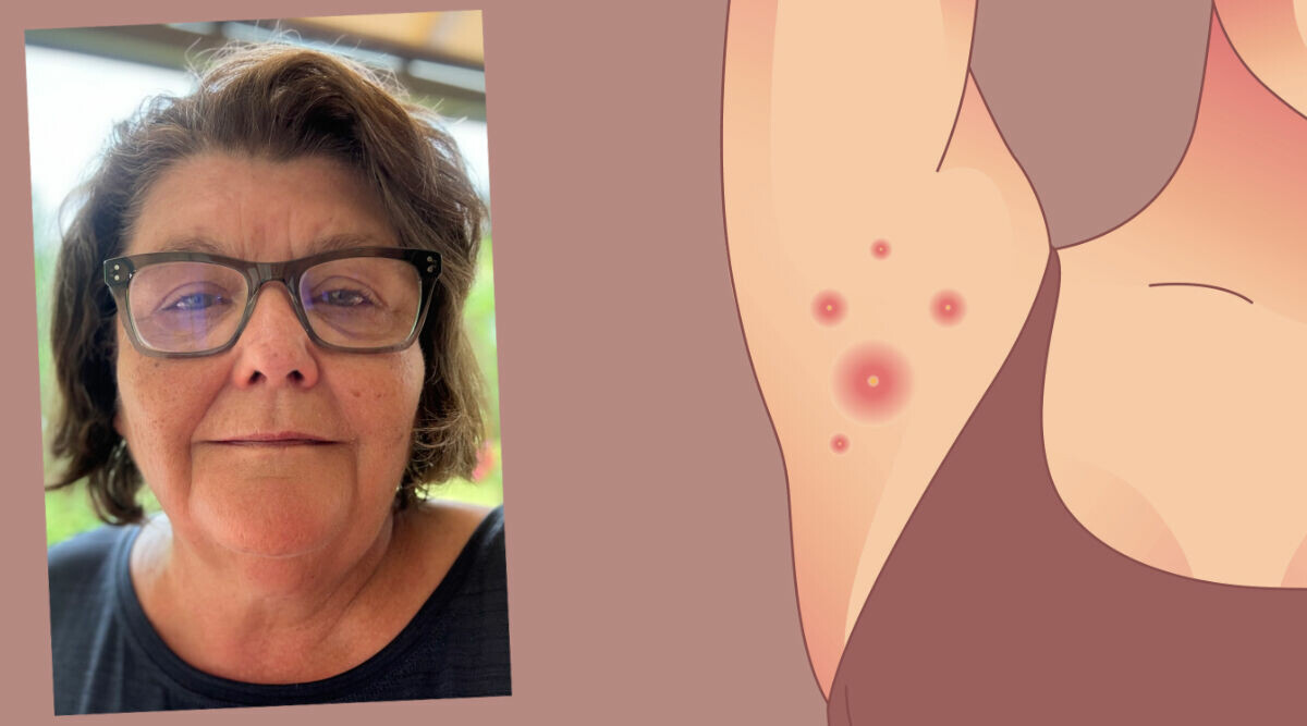 Annette lever med smärtande bölder: "kan spricka när som helst"