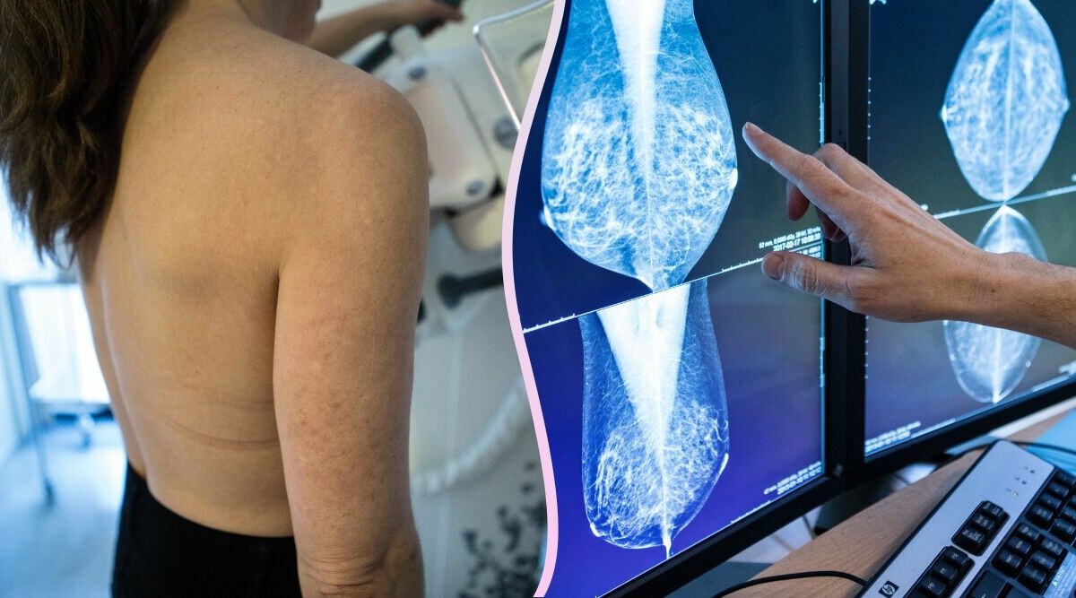 Studie: Det här trefaldigar risken för spridd bröstcancer
