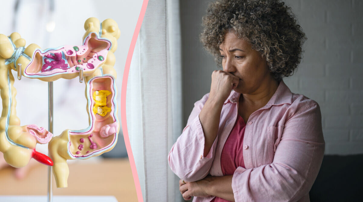 Jag tog bort polyper i tarmen – kommer jag få tarmcancer?