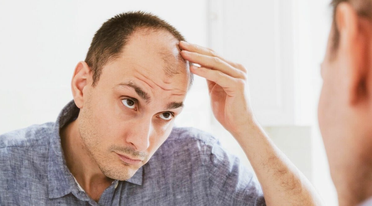 Plötsligt håravfall kan ha oväntade orsaker – läkaren förklarar