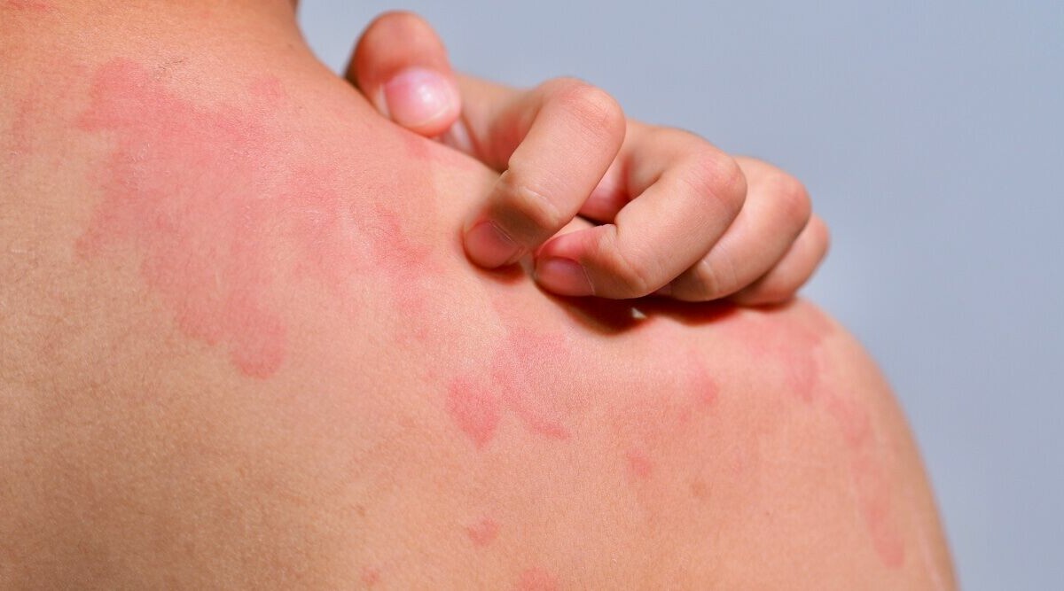 När nässelutslagen inte går över – vad kan vara orsaken?