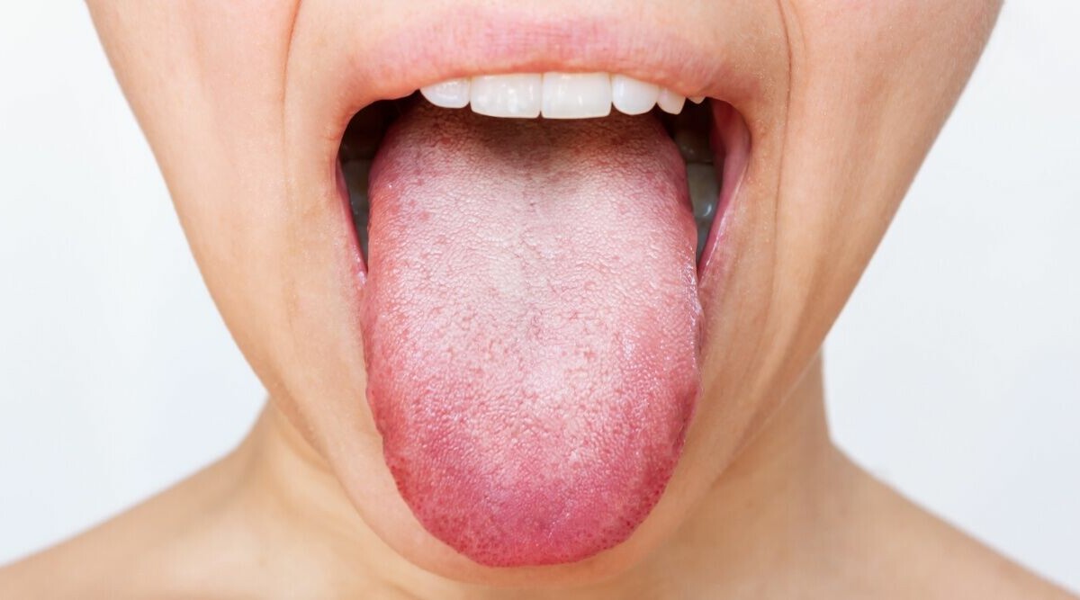 Läkaren: Därför bränner tungan fast allt ser normalt ut