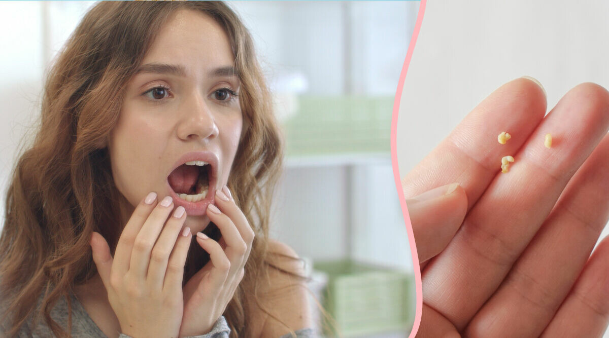 Illaluktande klumpar i halsen – så kan du ta bort tonsillstenar själv