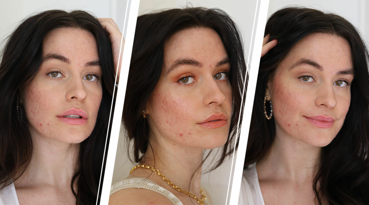 Sofia skämdes och isolerade sig på grund av akne – så vände det!