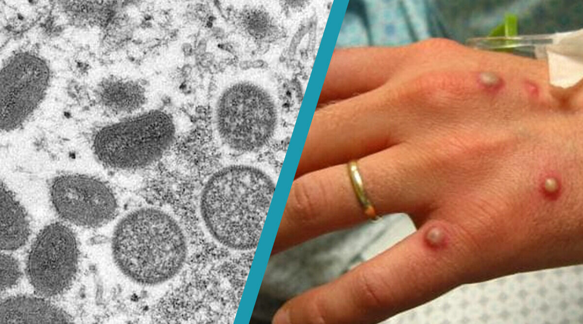 Apkoppor (monkeypox) klassas som allmänfarlig – symtom och vaccin