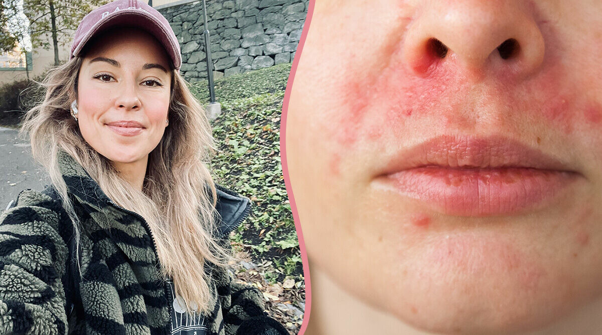 Så hanterar Alexandra Pizzoni hudsjukdomen Perioral dermatit