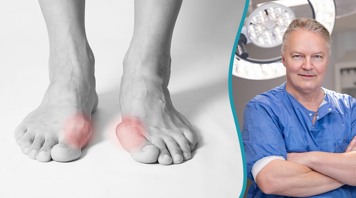 Hallux valgus – sned stortå: Så vet du om operation behövs