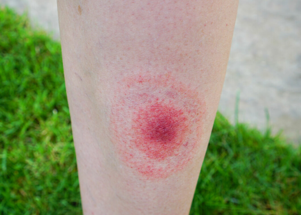 Ser du ett sånt här märke bör du kontakta läkare – det kan vara borrelia. Ser du ett sånt här märke bör du kontakta läkare – det kan vara borrelia.