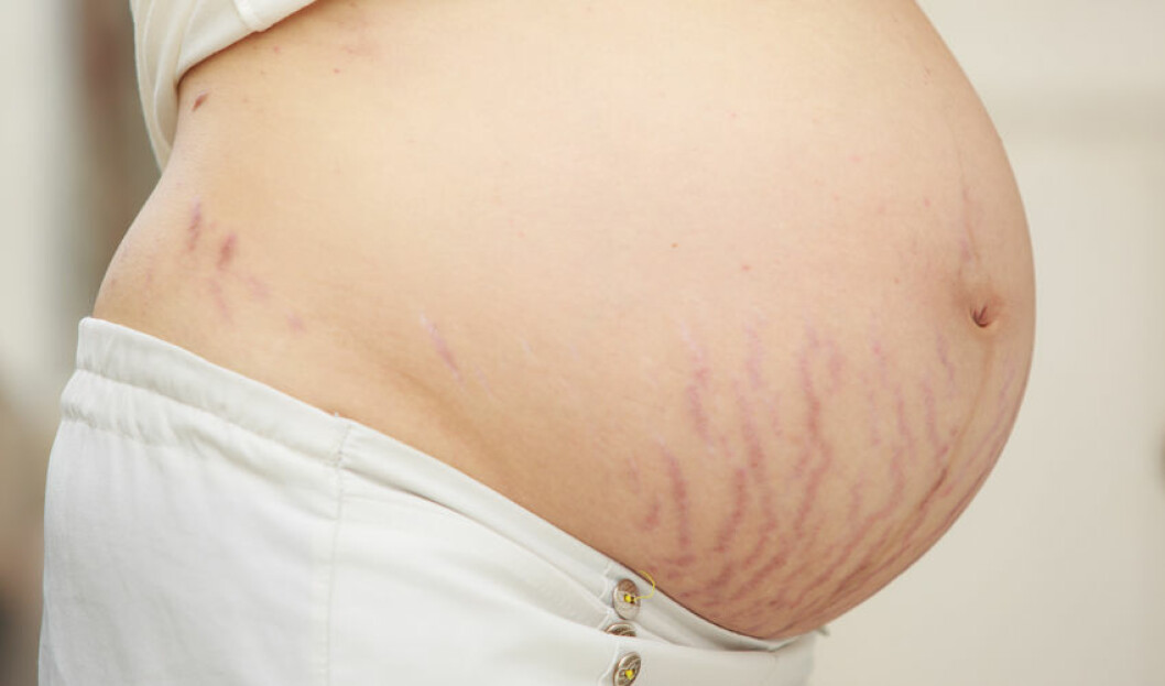Många gravida får bristningar när magen växer. Foto: IBL Bristningar, striae, i huden.