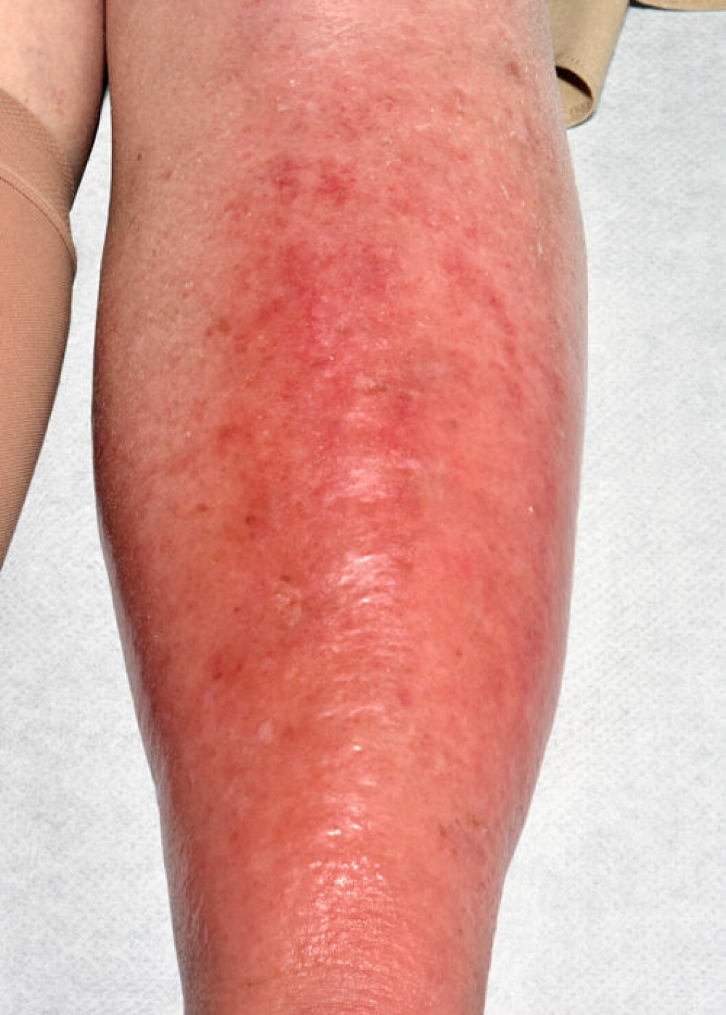 Cellulit är en bakterieinfektion som sätter sig i underhuden, dermis. Bild på cellulit.