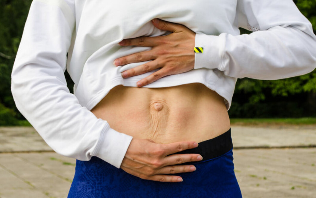 Diastasis Recti, delade magmuskler, kan behöva operation. Foto: TT Diastas mage hos kvinna.