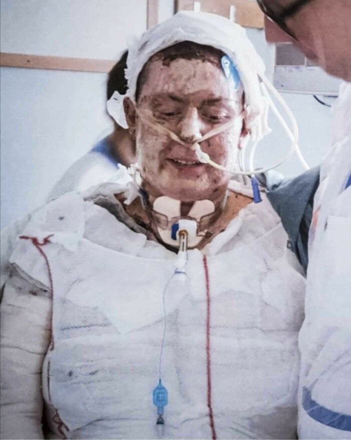 "Grannen samlade barnen och jag frågade gång på gång om jag fått ut alla och trots att de konstaterade att alla barn var räddade upprepade jag frågan". Foto: Privat Emma Schols brännskadad