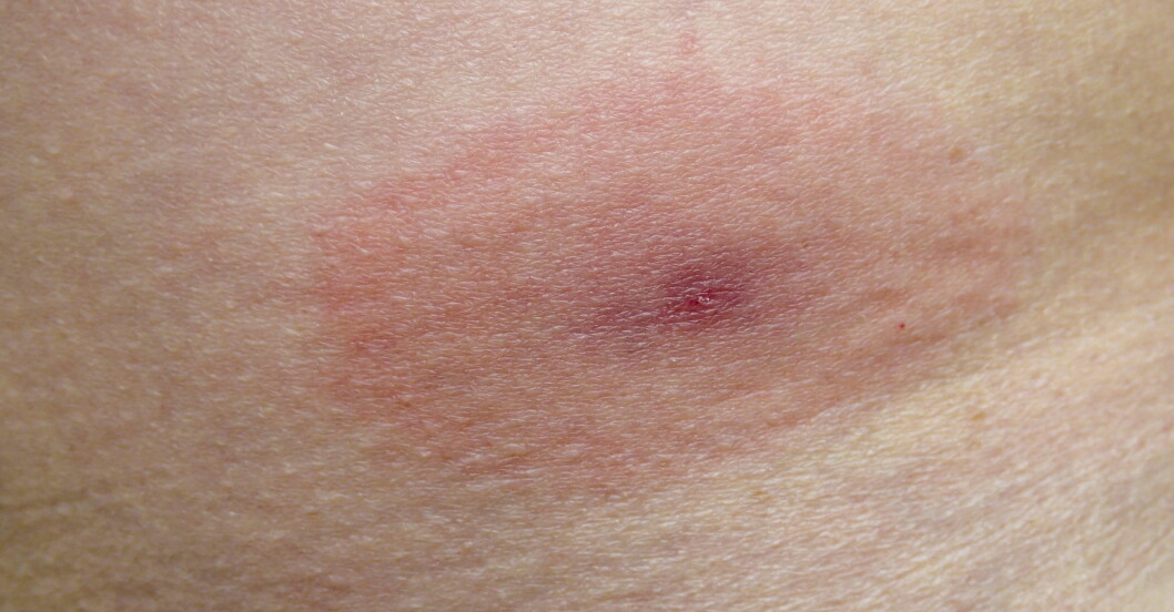 Ett fästingbett som efter mer än en vecka ser ut som en röd ring kan vara tecken på borrelia. Fästingbett med röd ring runt