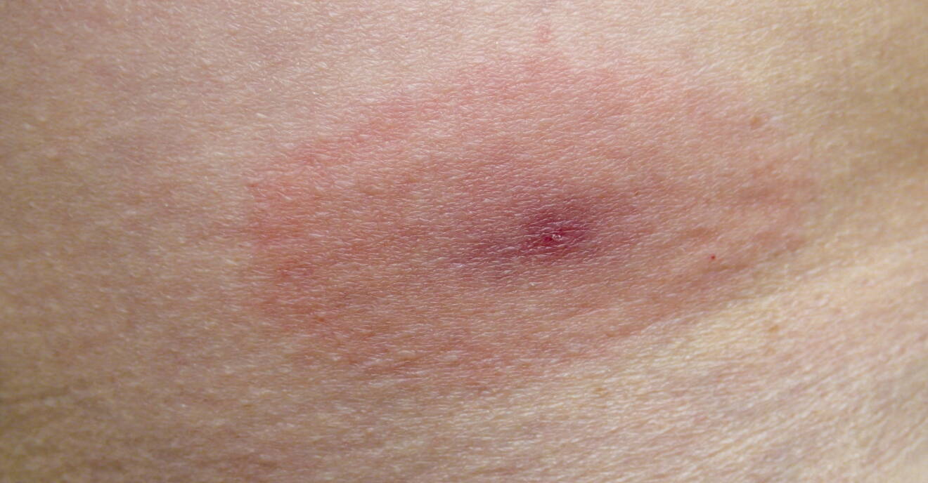 Fästingbett: Så behandlar du dem bäst enligt dermatologen | MåBra