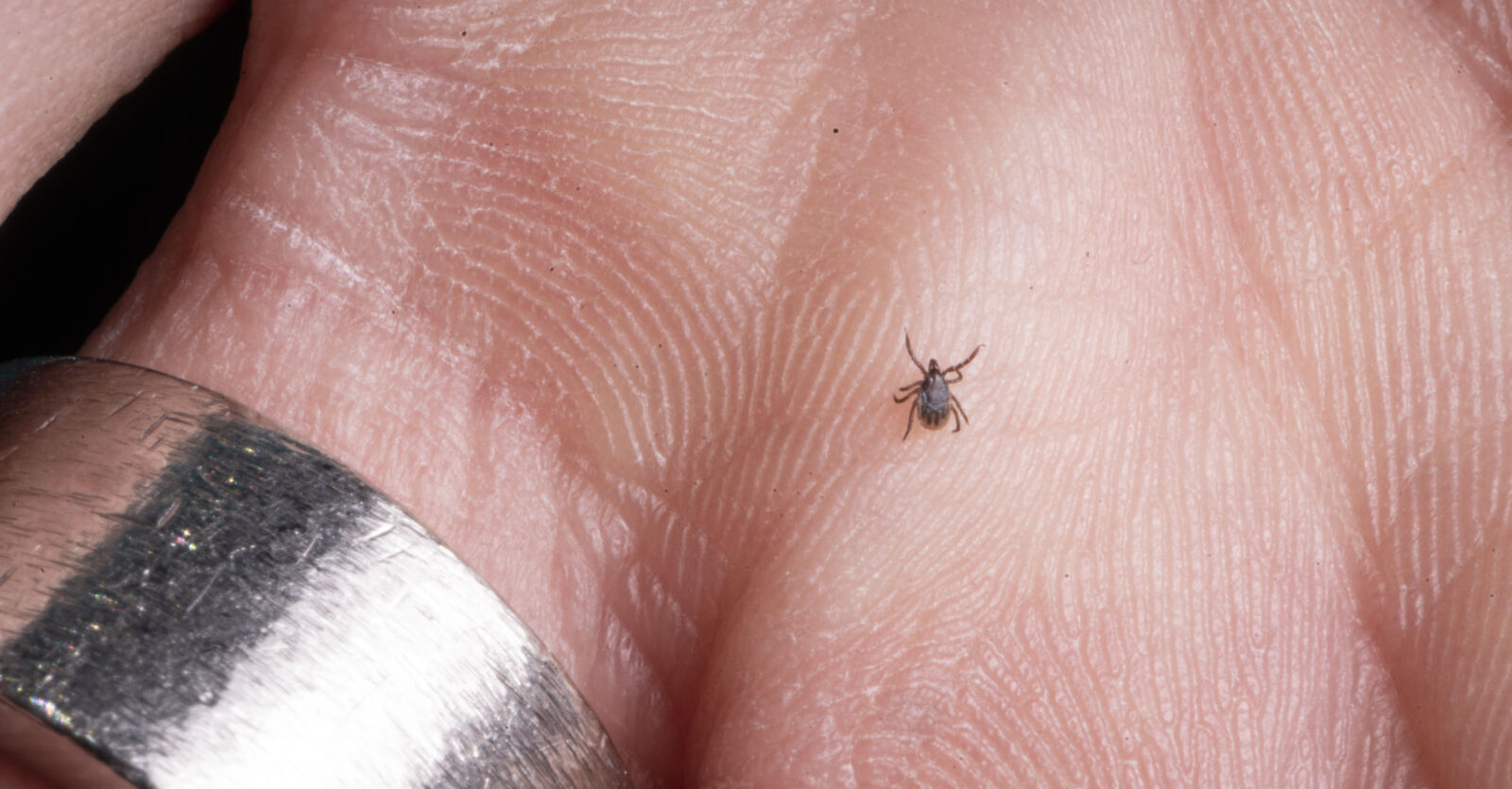 Fästingbett: Så behandlar du dem bäst enligt dermatologen | MåBra