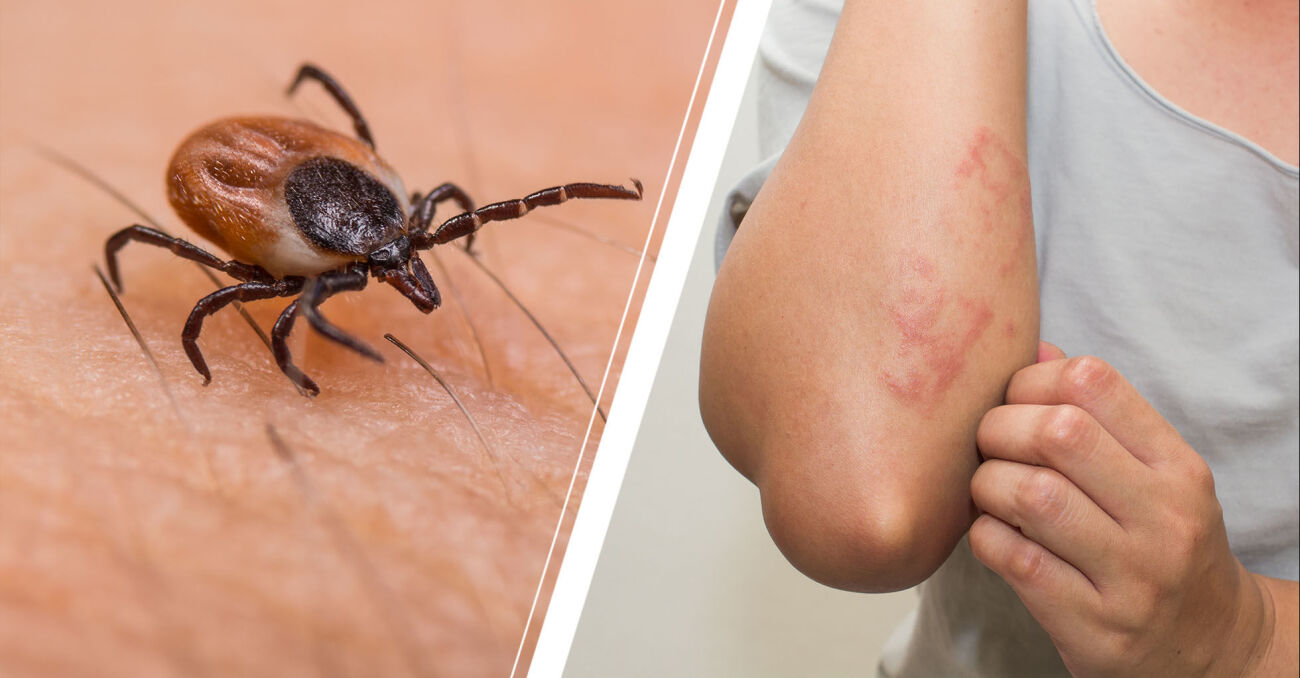 Fästingar och allergi mot kött - allt du behöver veta | MåBra