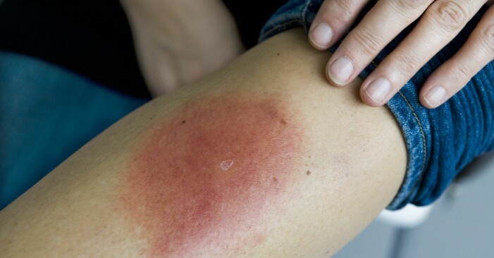 Så här kan rodnaden också se ut vid en borreliainfektion. Fästingbett som lett till borrelia