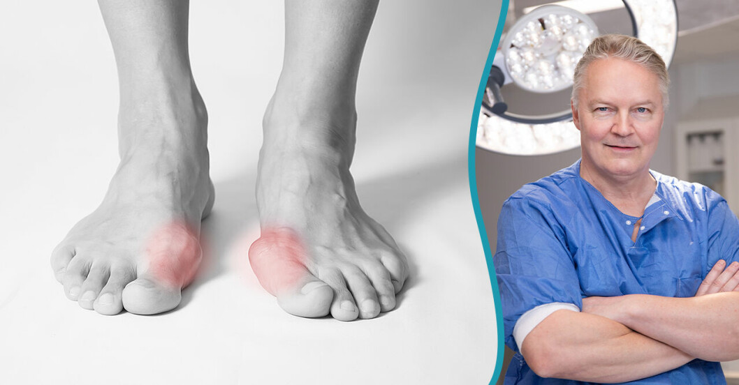Ett par fötter med hallux valgus och kirurgen Jouko Kivioja