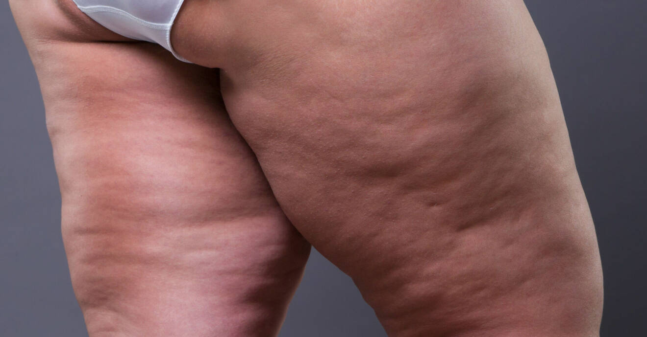 Fettdepåer på ben kan vara den okända sjukdomen lipödem.