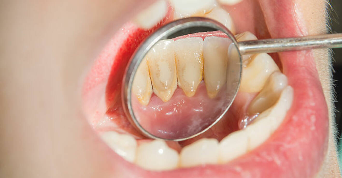 Öppen mun med tandläkarspegel som visar brun beläggning på tänder