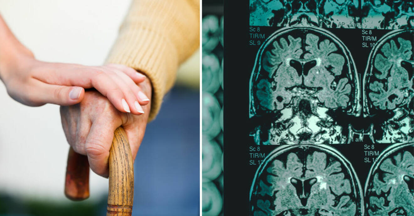 Ny metod kan upptäcka Alzheimers sjukdom tidigare.