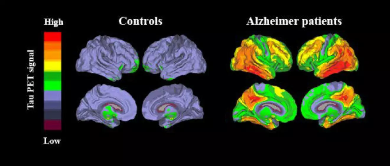 Ny metod för att upptäcka Alzheimers