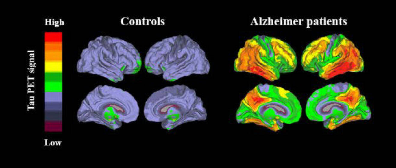 Ny metod för att upptäcka Alzheimers