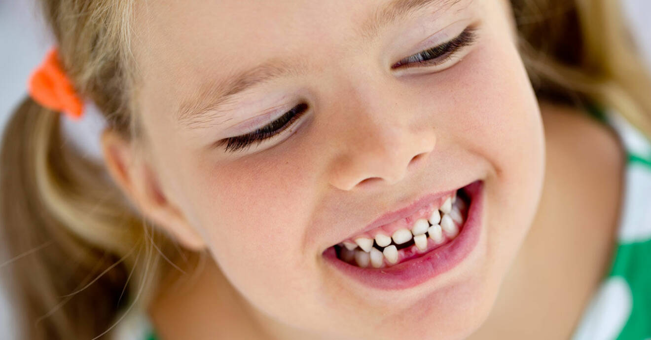 Svenska barn har fått sämre tänder.