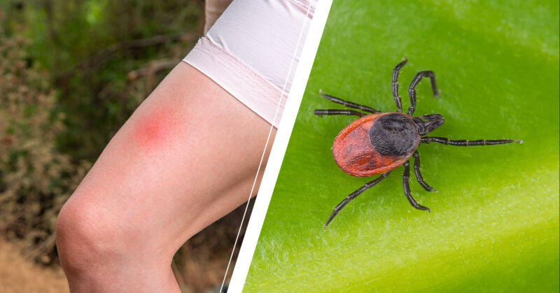 Fästingbett: Så behandlar du dem bäst enligt dermatologen | MåBra