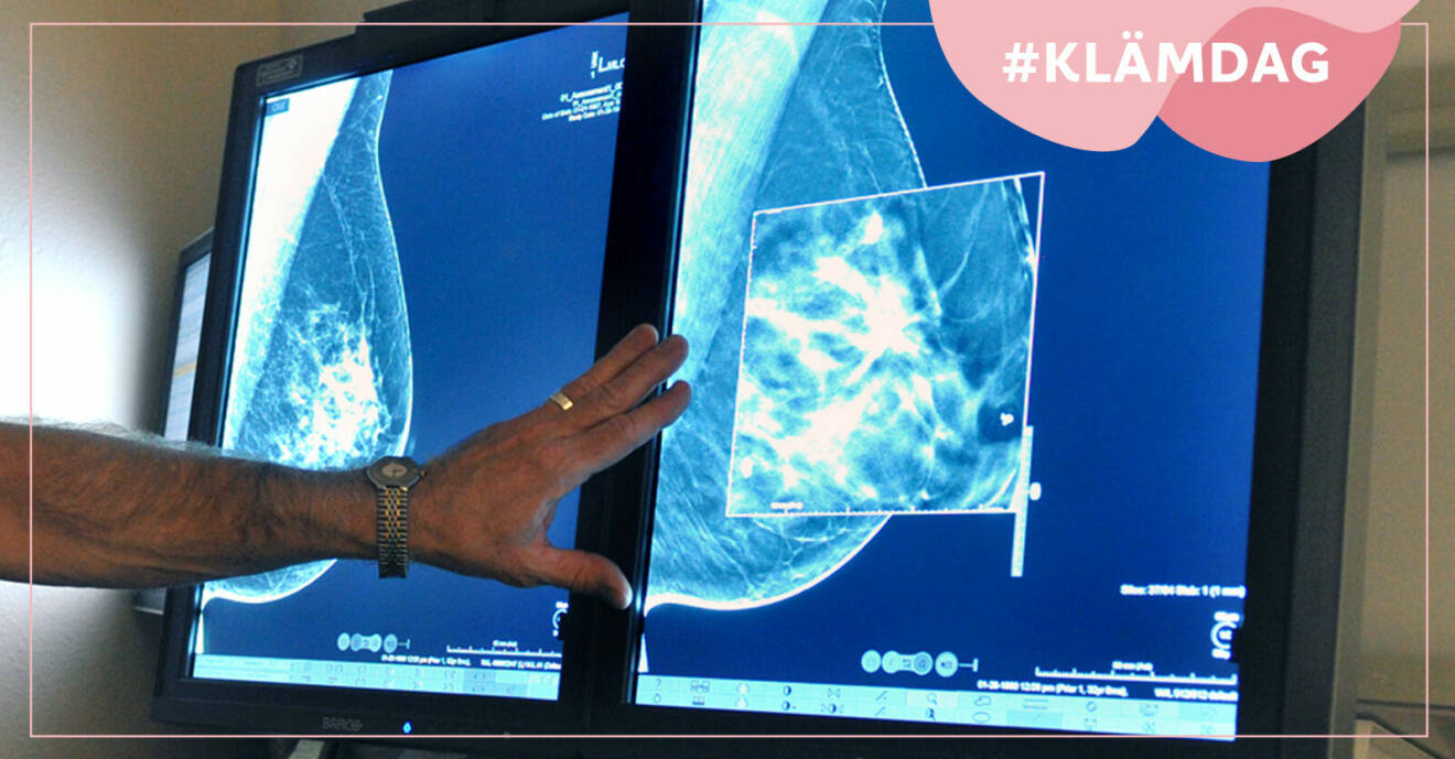 Röntgenbilder av ett bröst som tagits under 3d-mammografi.