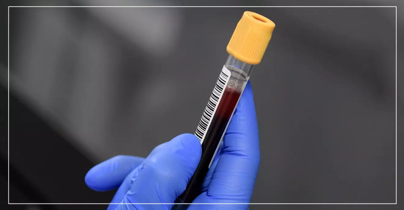 Blodprov för test av hiv.