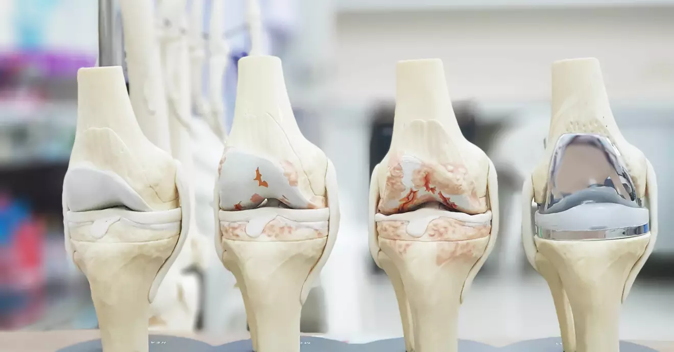 Prototyper av knän med olika stadier av artros