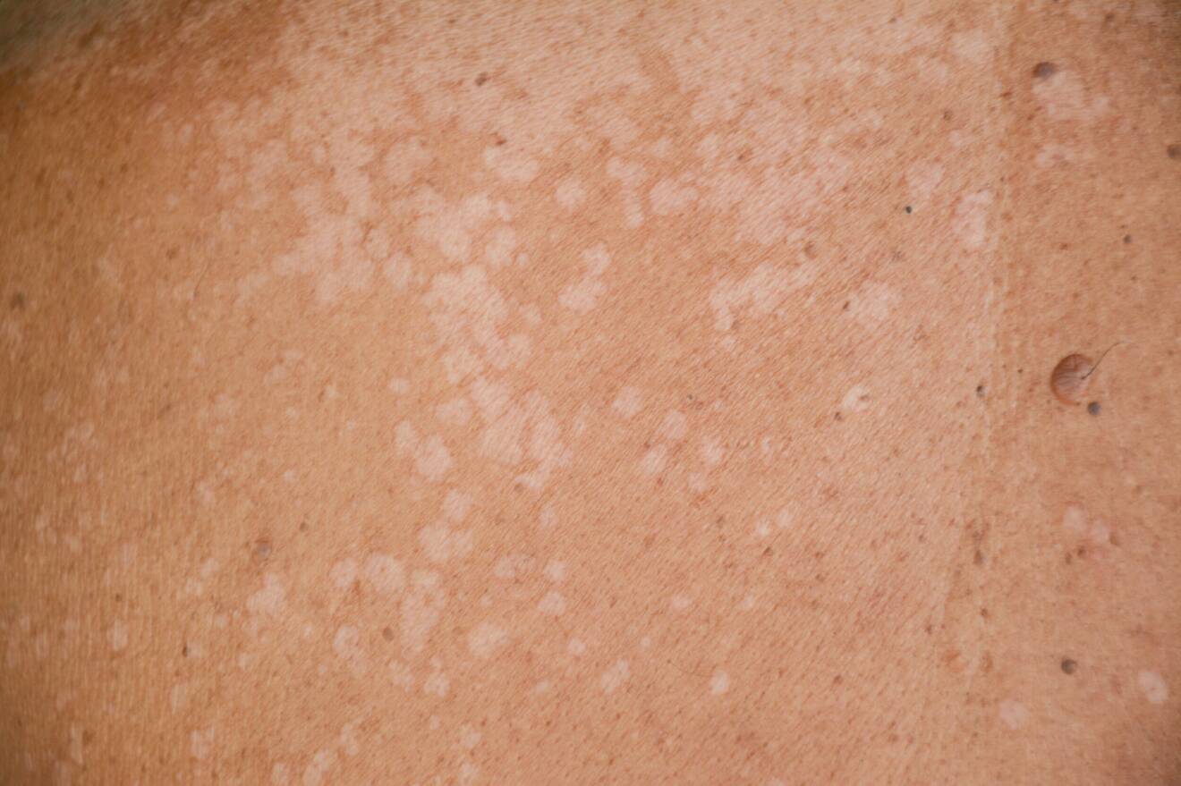 Svampinfektionen pityriasis versicolor ger ljusa fläckar på huden
