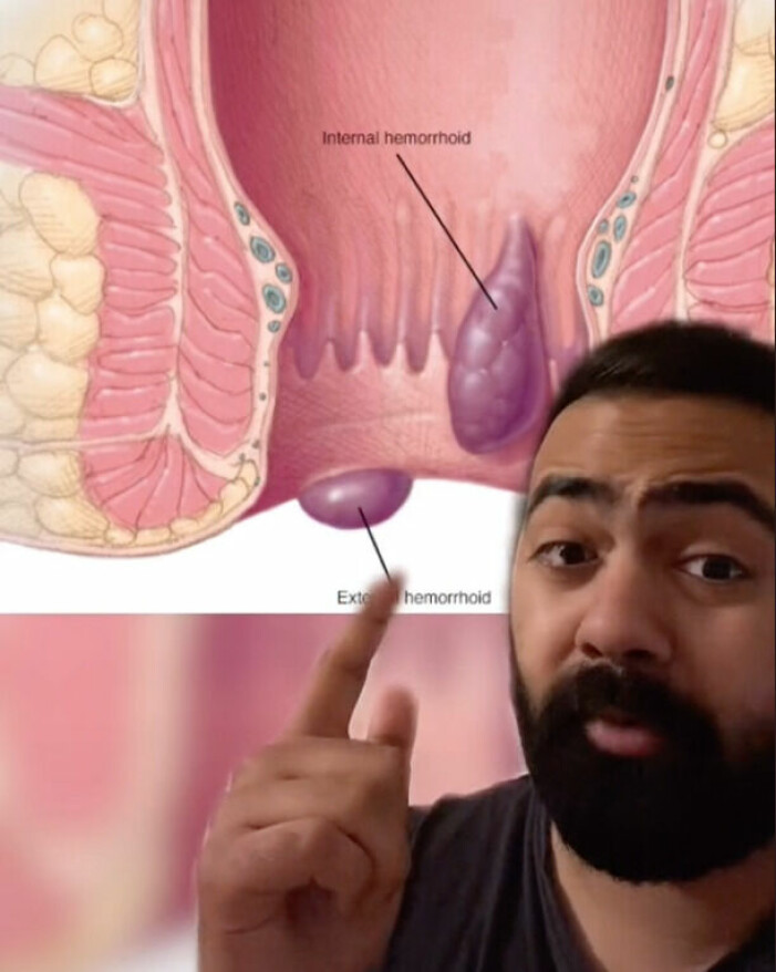 I videon visar läkaren hur hemorrojder uppstår. Foto: TikTok@drkaranr. Karan Rajan visar hur hemorrojder uppstår