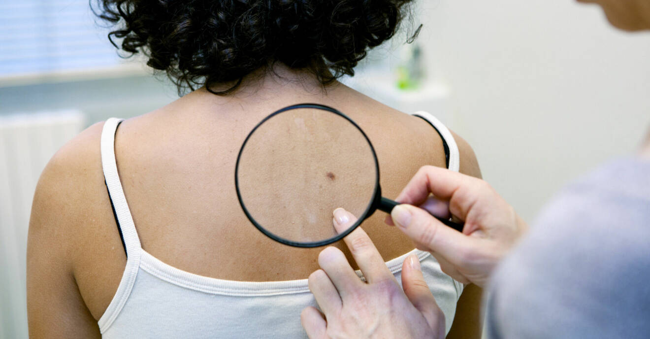 Kvinna med hudfläck på ryggen hos doktorn