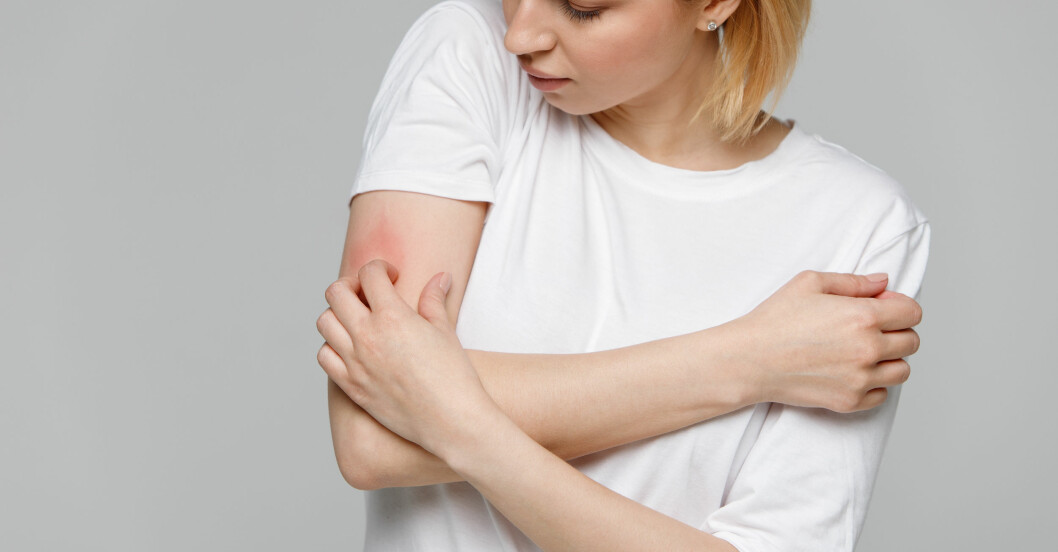 Rektionen kan ömma och klia, men enligt läkaren är det inte farligt. kvinna med covid-vaccin-arm