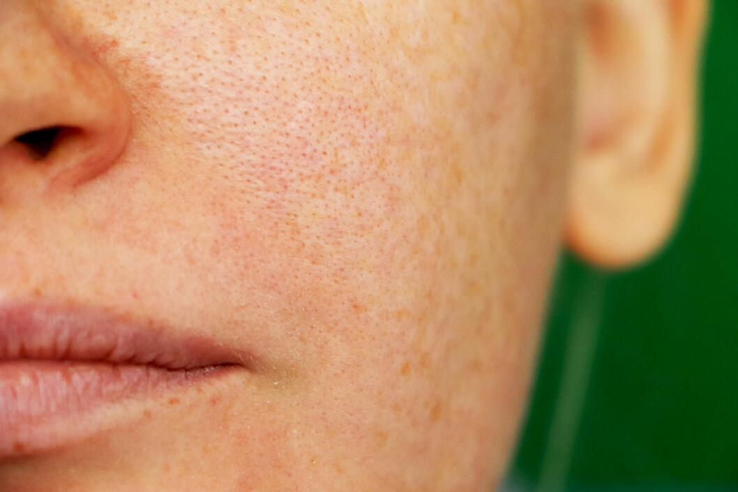 Melasma påminner om fräknar, men ska inte förväxlas med dem. Kvinna med melasma