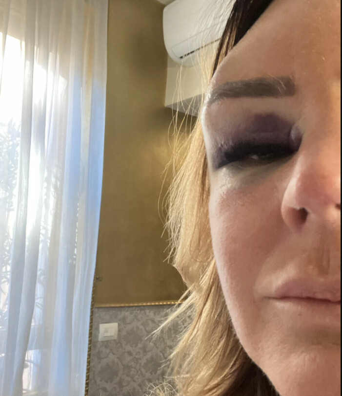 Magdalena graaf svullet ögonbryn