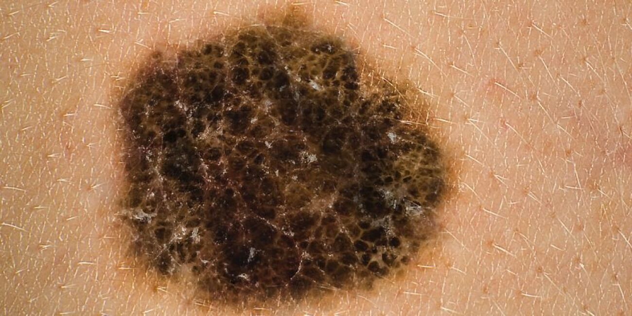 Bilder på hudcancer – så upptäcker du sjukdomen | MåBra