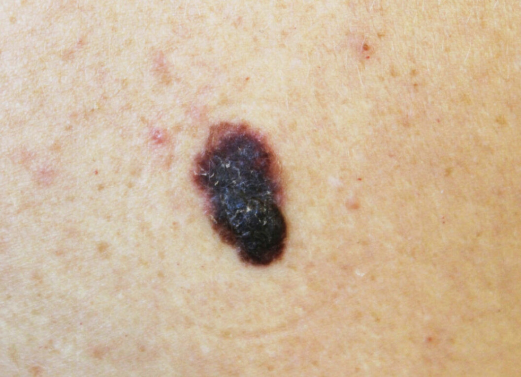 malignt melanom.