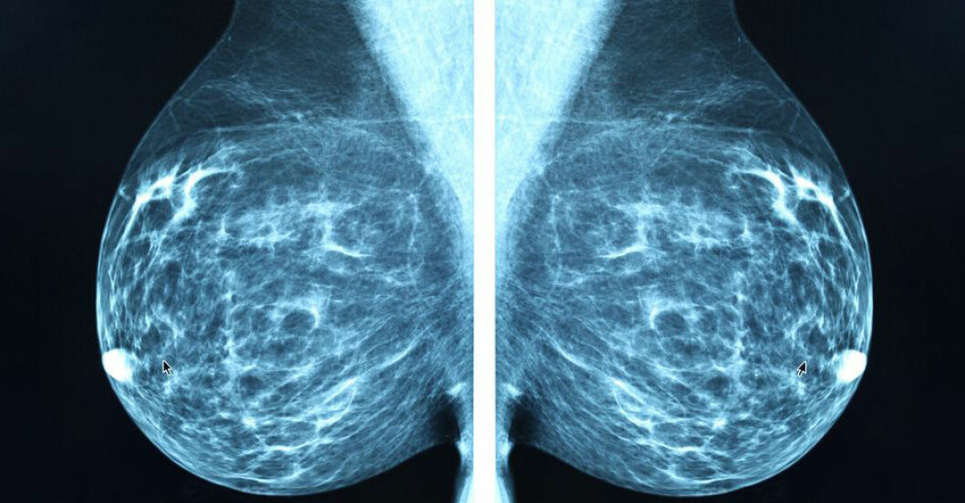 Kvinnor mellan 40 och 74 år kallas regelbundet till mammografi. Mammografibild