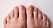 Fötter med missfärgad stortånagel på grund av nagelsvamp.